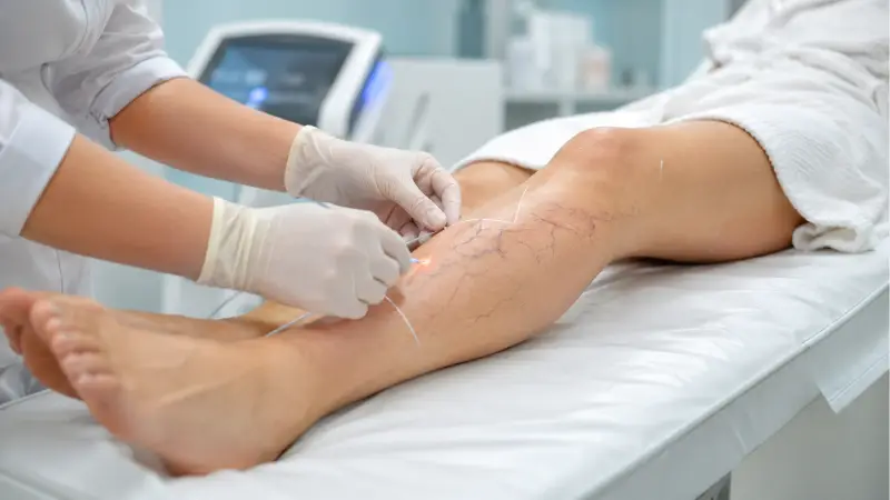 Nicht-operative Methoden zur Krampfadernbehandlung in Hamburg Nicht-operative Methoden zur Krampfadernbehandlung in Hamburg: Kompressionsstrümpfe, Sklerotherapie und Lebensstilmaßnahmen