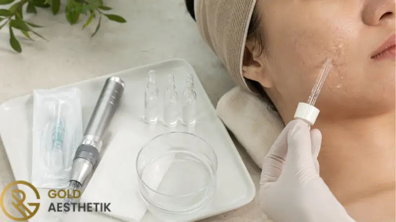 Microneedling bei Aknenarben | Ergebnis, Anzahl der Sitzungen und Pflege