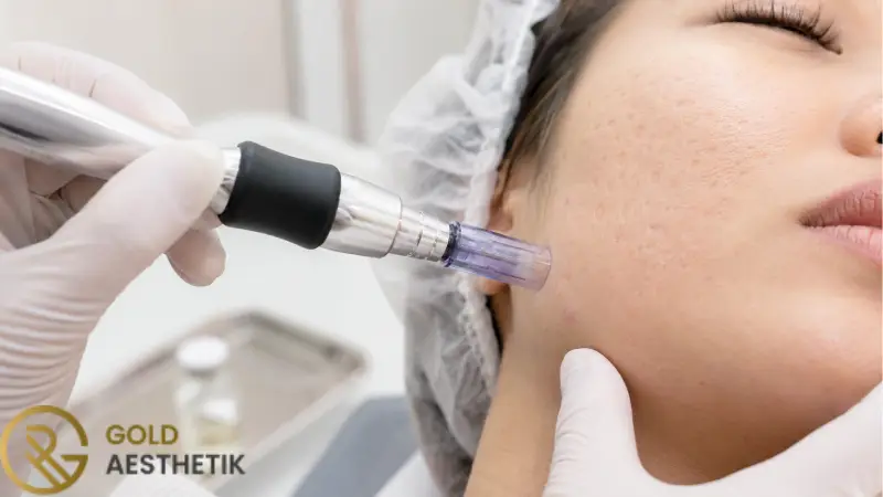 Microneedling bei Aknenarben | Ergebnis, Anzahl der Sitzungen und Pflege 1 Wirkungsweise von Microneedling bei atrophischen Aknenarben