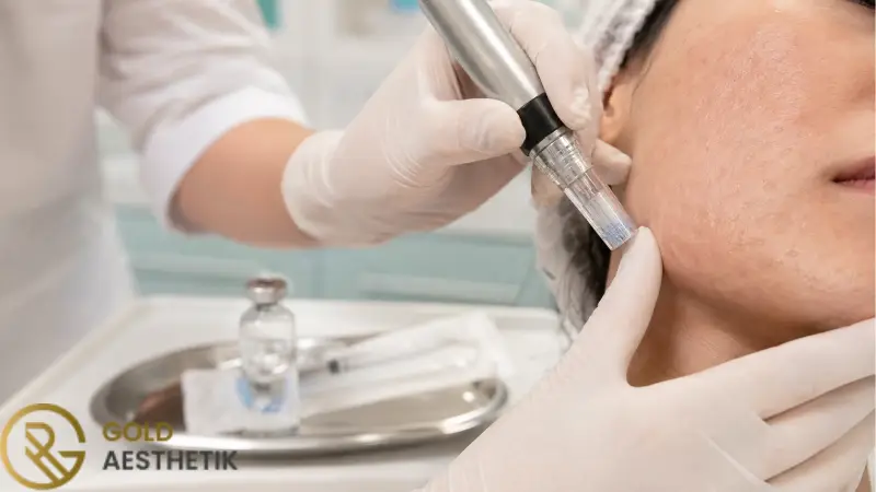 Microneedling bei Aknenarben | Ergebnis, Anzahl der Sitzungen und Pflege 4 Überprüfung der Kombinationsbehandlung für verschiedene Aknenarben